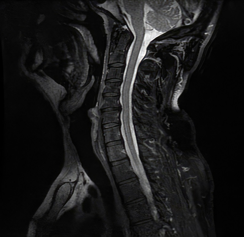 MRI and ultrasound data analysis for endometriosis